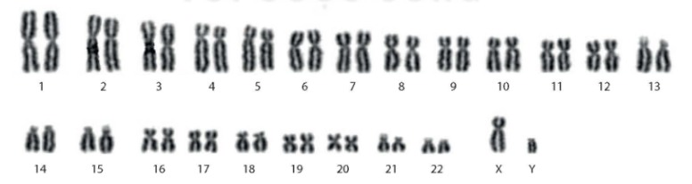Bộ NST đồ karyotype người bình thường
