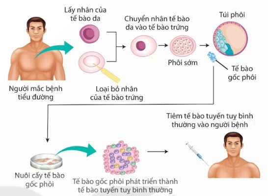 Liệu pháp tế bào gốc chữa bệnh tiểu đường type 1 (Ảnh Sách KNTT)