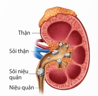 Sỏi đường tiết niệu (Ảnh Sách KNTT)