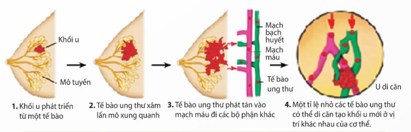Sự sinh trưởng và di căn của khối u ác tính (Ảnh Sách KNTT)