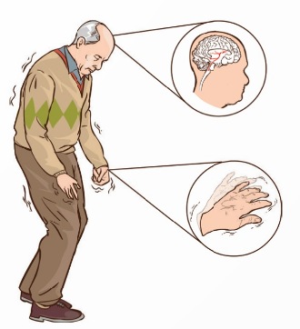 Bệnh Parkinson