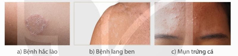 Biểu hiện bệnh hắc lào, lang ben, mụn trứng cá