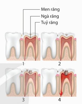 Các giai đoạn sâu răng
