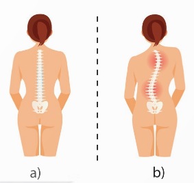 Cột sống bình thường (a) và cột sống cong vẹo (b)