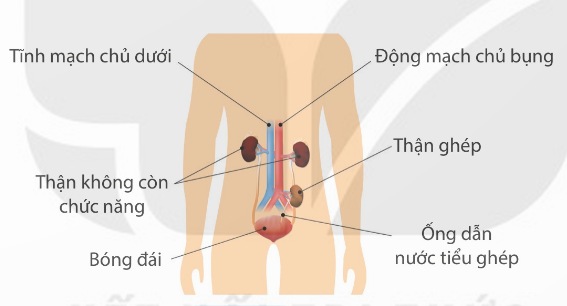 Ghép thận