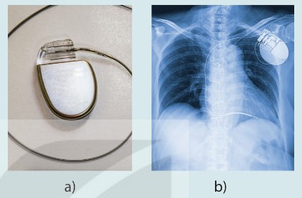 Máy khử rung tim và hình ảnh đặt máy ở bệnh nhân