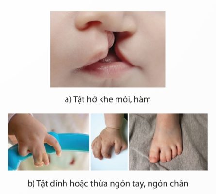 Một số tật di truyền ở người