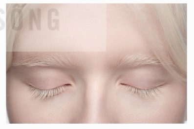 Người mắc bệnh bạch tạng