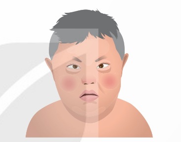 Người mắc hội chứng Down