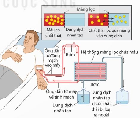 Sơ đồ chạy thận nhân tạo