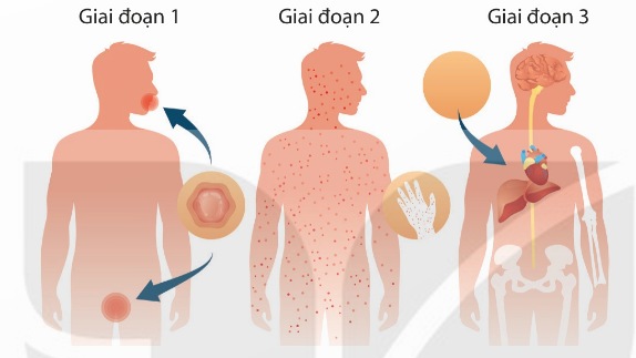 Triệu chứng bệnh giang mai qua 3 giai đoạn