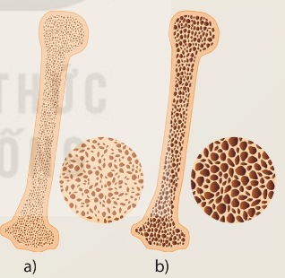 Xương người bình thường (a) và xương người bị loãng xương (b)