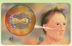 Người bị bệnh đậu mùa và virus gây bệnh