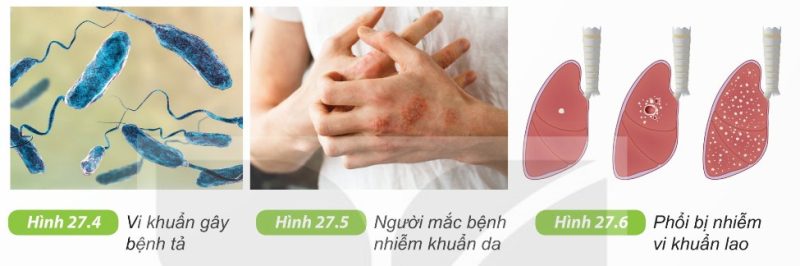 Vi khuẩn gây bệnh tả, nhiễm khuẩn da, lao phổi