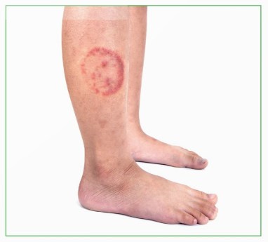 Vùng da của người mắc bệnh hắc lào